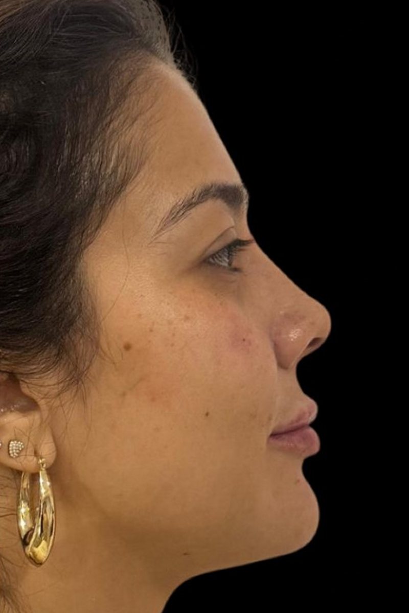 Caso 4, perfil: depois
