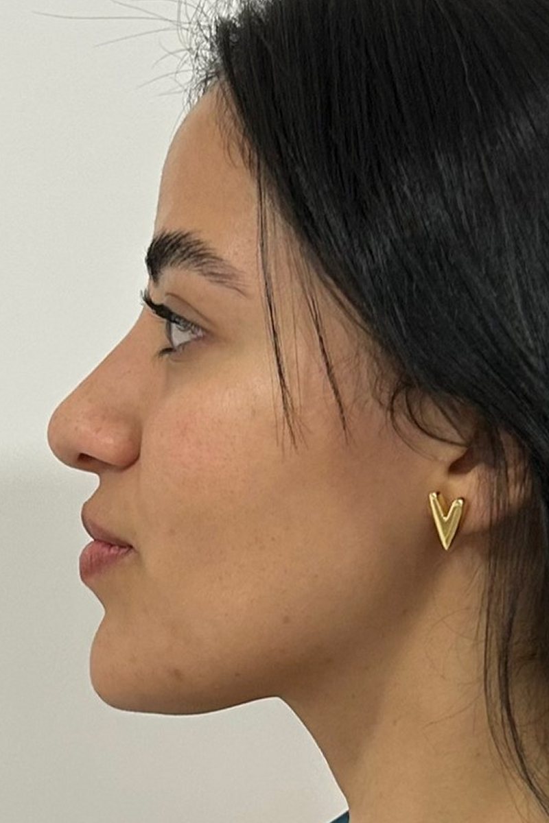 Caso 5, perfil: antes
