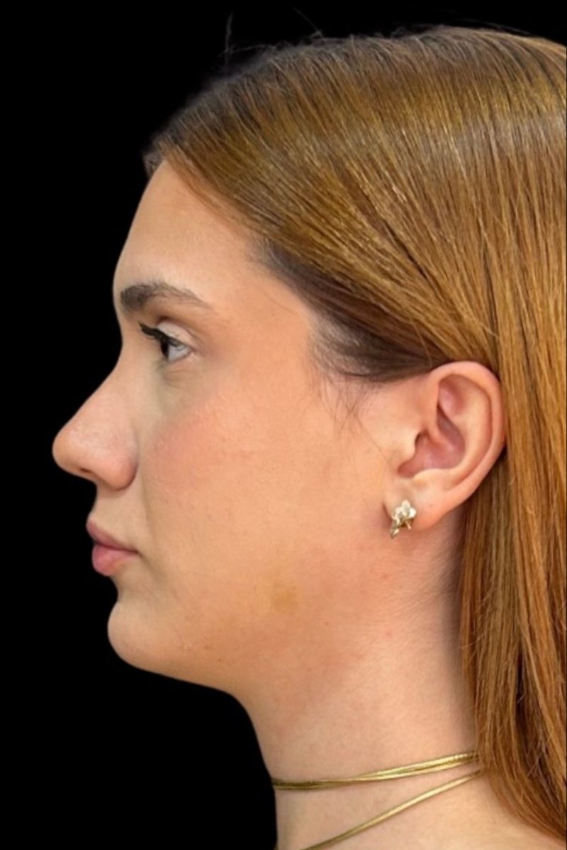 Caso 6, perfil: antes